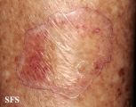 porokeratosis of mibelli