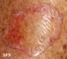 porokeratosis of mibelli
