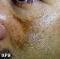 melasma