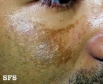 melasma