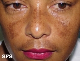 melasma