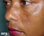 melasma