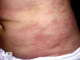 parapsoriasis en plaques