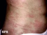 parapsoriasis en plaques