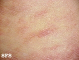 parapsoriasis en plaques