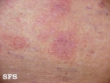 parapsoriasis en plaques
