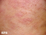 parapsoriasis en plaques