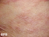 parapsoriasis en plaques
