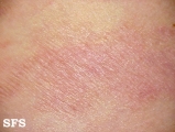 parapsoriasis en plaques