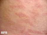 parapsoriasis en plaques