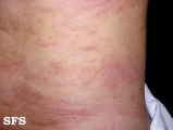 parapsoriasis en plaques