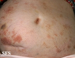 parapsoriasis en plaques