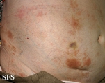 parapsoriasis en plaques