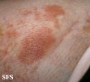 parapsoriasis en plaques