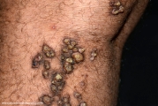 keratoachantoma - multiple keratoachantoma