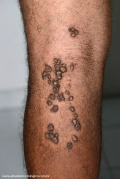 keratoachantoma - multiple keratoachantoma