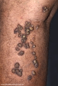 keratoachantoma - multiple keratoachantoma