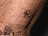 keratoachantoma - multiple keratoachantoma