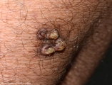keratoachantoma - multiple keratoachantoma