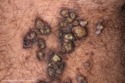 keratoachantoma - multiple keratoachantoma