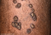 keratoachantoma - multiple keratoachantoma