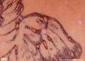 henna tattooing dermatitis