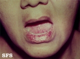 osler-weber-rendu disease