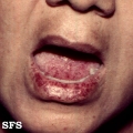 osler-weber-rendu disease