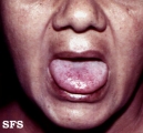 osler-weber-rendu disease