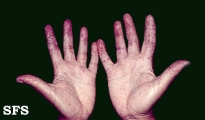 osler-weber-rendu disease
