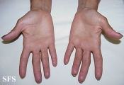 osler-weber-rendu disease