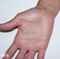 osler-weber-rendu disease