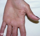 osler-weber-rendu disease