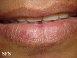 osler-weber-rendu disease
