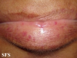 osler-weber-rendu disease