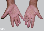 osler-weber-rendu disease