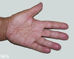 osler-weber-rendu disease