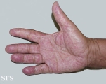 osler-weber-rendu disease