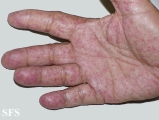 osler-weber-rendu disease