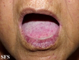 osler-weber-rendu disease