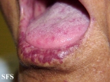 osler-weber-rendu disease