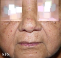 osler-weber-rendu disease