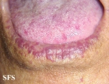 osler-weber-rendu disease