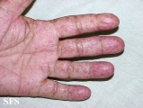 osler-weber-rendu disease