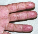 osler-weber-rendu disease