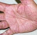 osler-weber-rendu disease