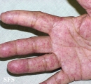 osler-weber-rendu disease