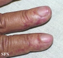 osler-weber-rendu disease