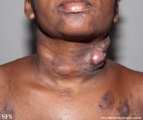 Cutaneous T-cell_lymphoma
