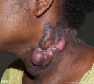 Cutaneous T-cell_lymphoma